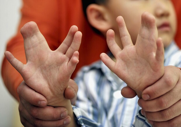 В Днепре врачи прооперировали мальчика со сросшимися пальцами. Фото: likarni.com