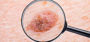 Запишись заранее: на следующей неделе одесситов приглашают бесплатно обследовать родинки 