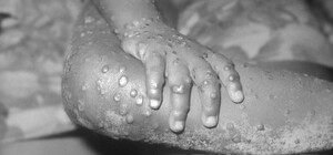 У МОЗ розповіли, як передається мавпяча віспа та які симптоми