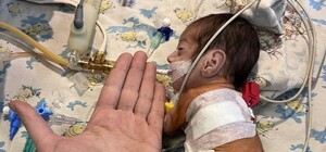 В Одесі прооперували двох немовлят із вродженими вадами серця