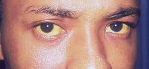 В Україні підтвердився спалах вірусного гепатиту А: що це та як лікувати?