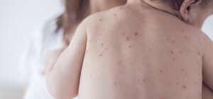 Спалах кору: Київські медики закликають до вакцинації