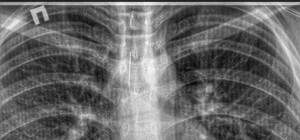 В Одесской области врачи вытащили из трахеи подростка иголку