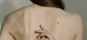 Когда нужно удалять родинки: советы дерматолога  