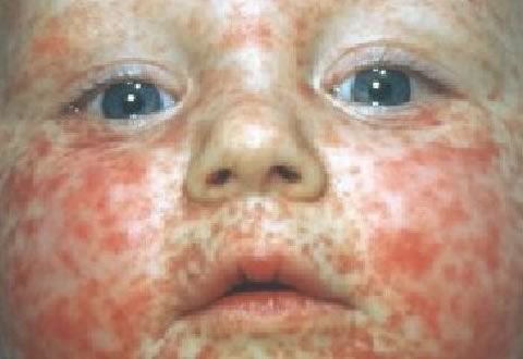 Дети больше всего рискуют заразиться корью. Фото с сайта deti.health-ua.org