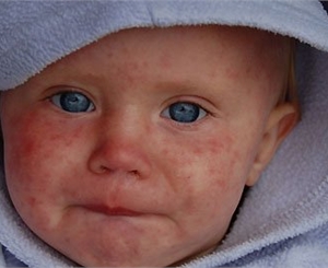 Дети переносят болезнь проще, чем взрослые. Фото с сайта tsn.ua