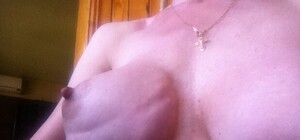 Как врачи изуродовали луганчанке грудь. Шокирующие фото