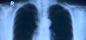 Где в октябре в Киеве можно бесплатно пройти флюорографию. Адреса