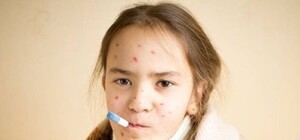 Не відступає: на Львівщині 37 дітей захворіли на кір цього тижня