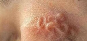 Размером в 10 сантиметров: из глаза еще одной харьковчанки достали червя