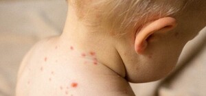 Не врятували: у львівській лікарні від кору помер дворічний хлопчик