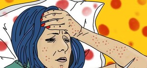 Печальная статистка: Харьковская область — в тройке лидеров по заражению корью