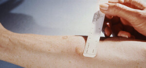 Массовое заболевание туберкулезом в Керчи: власти сделали заявление