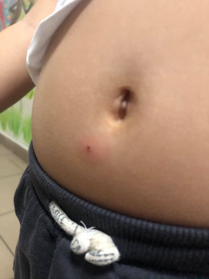 Так выглядело место укуса / фото: fb Яна Демченко, &lrm;ж/м Сокіл, м. Дніпро