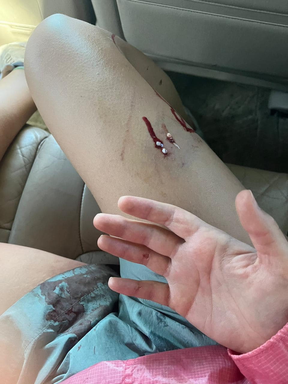 Постраждала дівчинка –