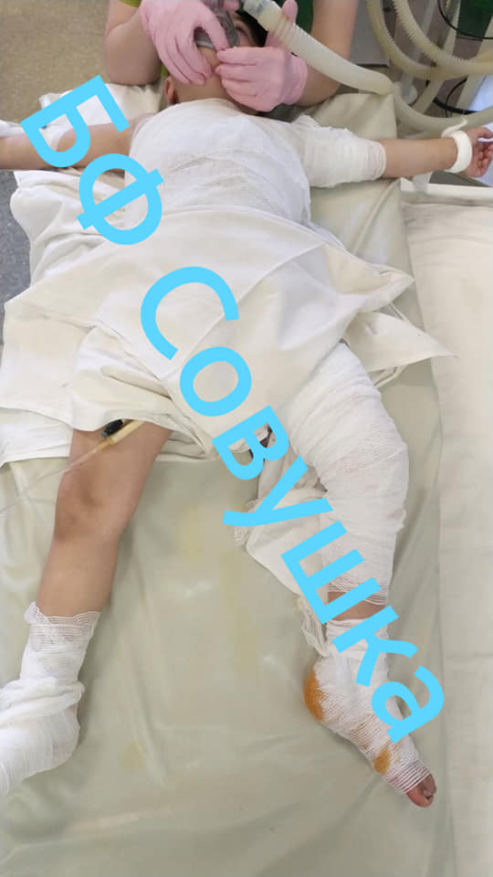 Мальчик облился кипятком / фото: fb Александра Сова-Тимощенкова