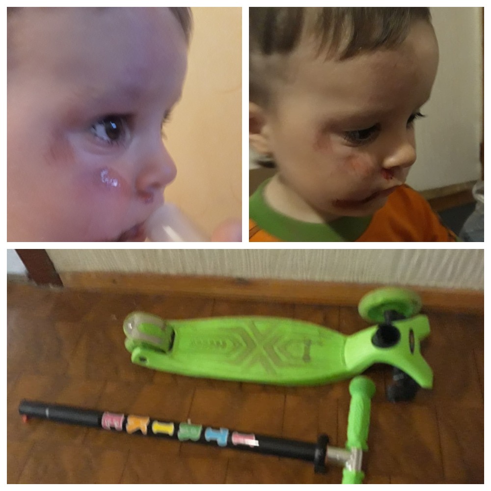 У ребенка ссадины на лице и сломанный самокат / фото: fb Elena Goncharova