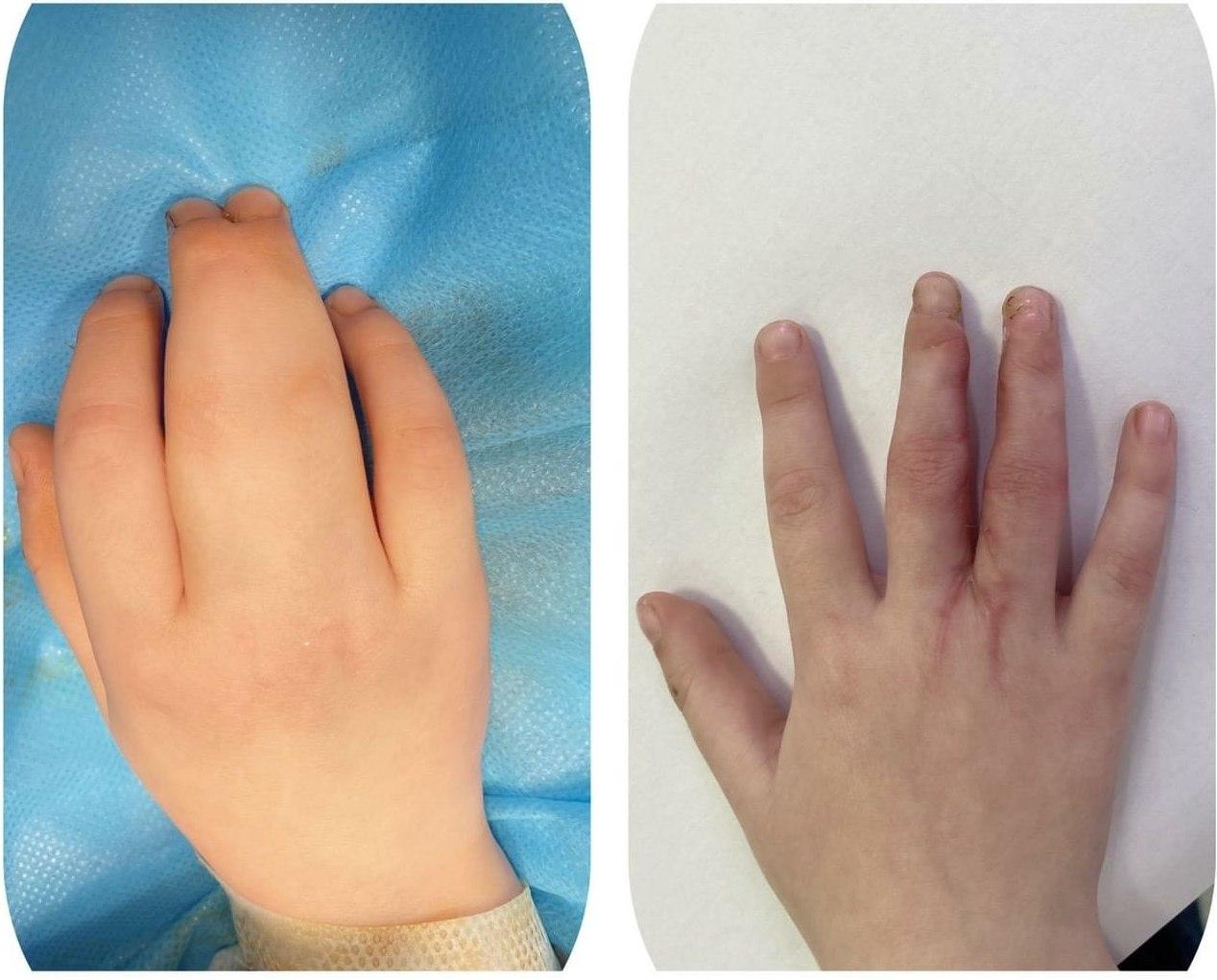 Врачи разделили сросшиеся пальчики ребенка. Фото: fb Дніпропетровська обласна дитяча лікарня