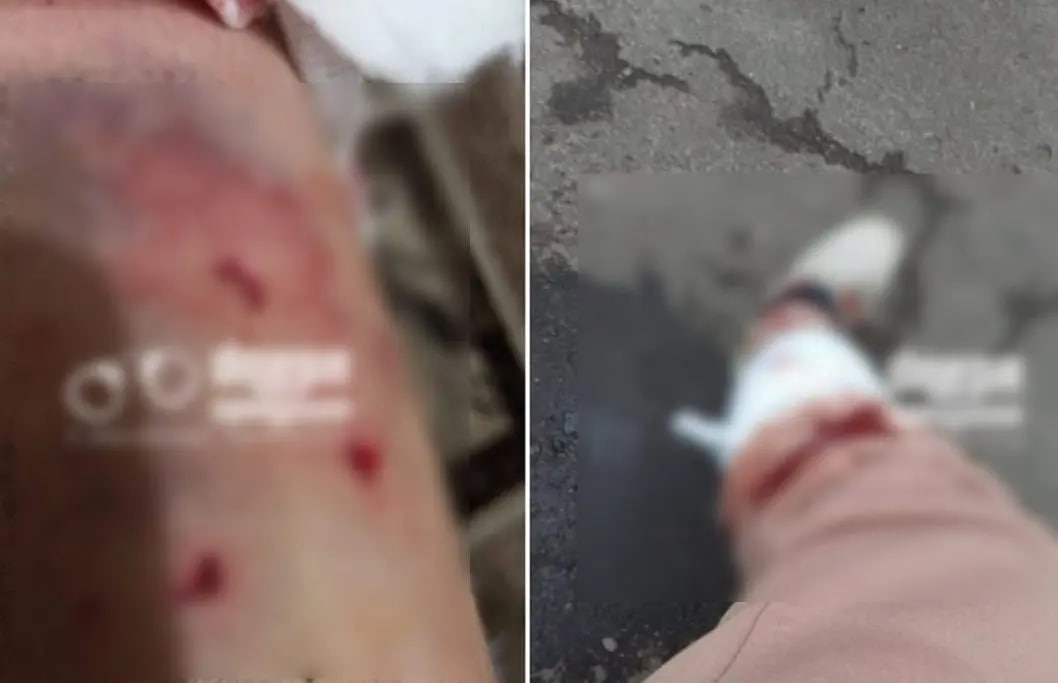 У Дніпрі собака покусав дівчину з дитиною на руках.