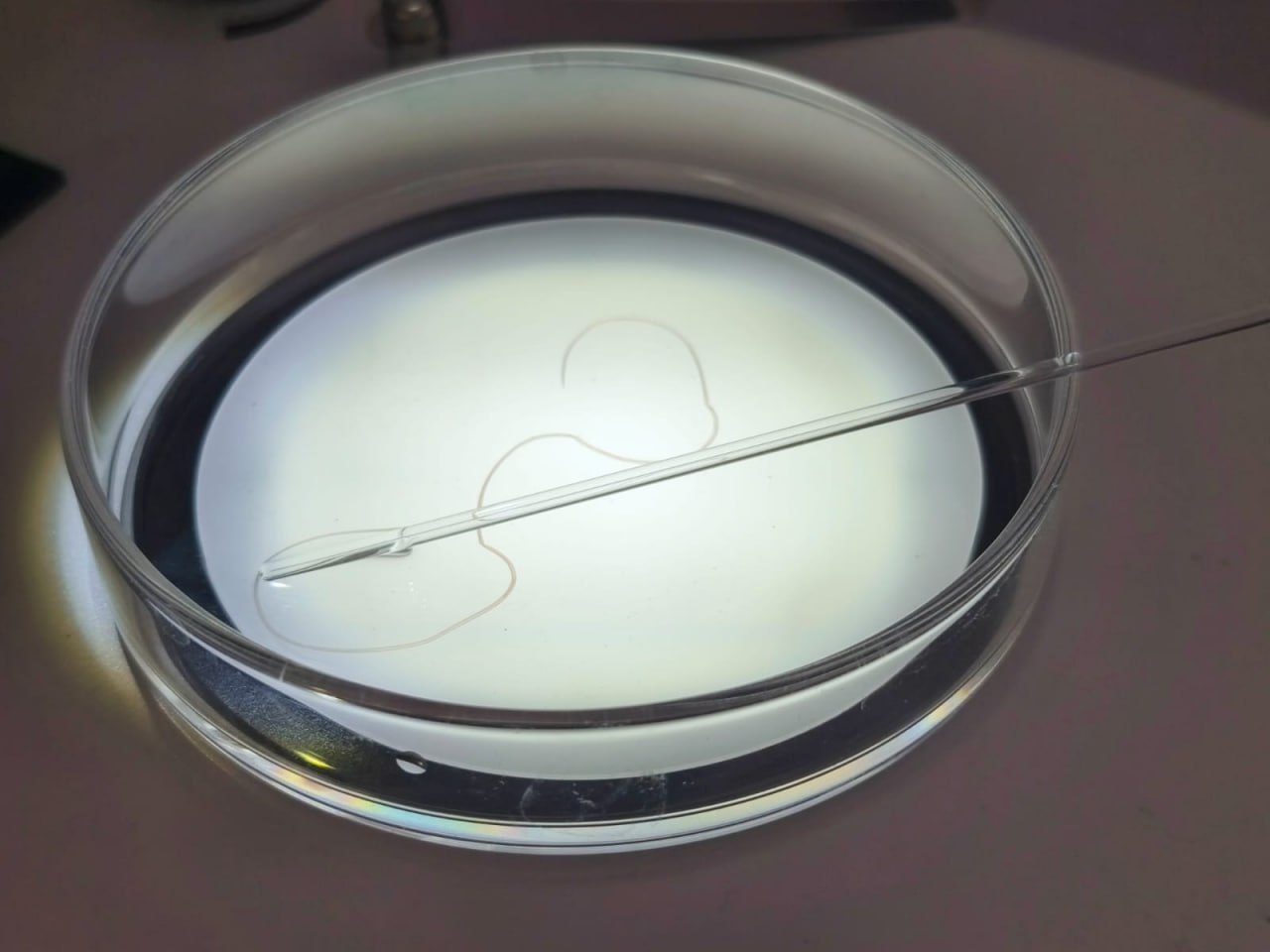 У мешканки Запоріжжя лікарі виявили під шкірою жахливого паразита.