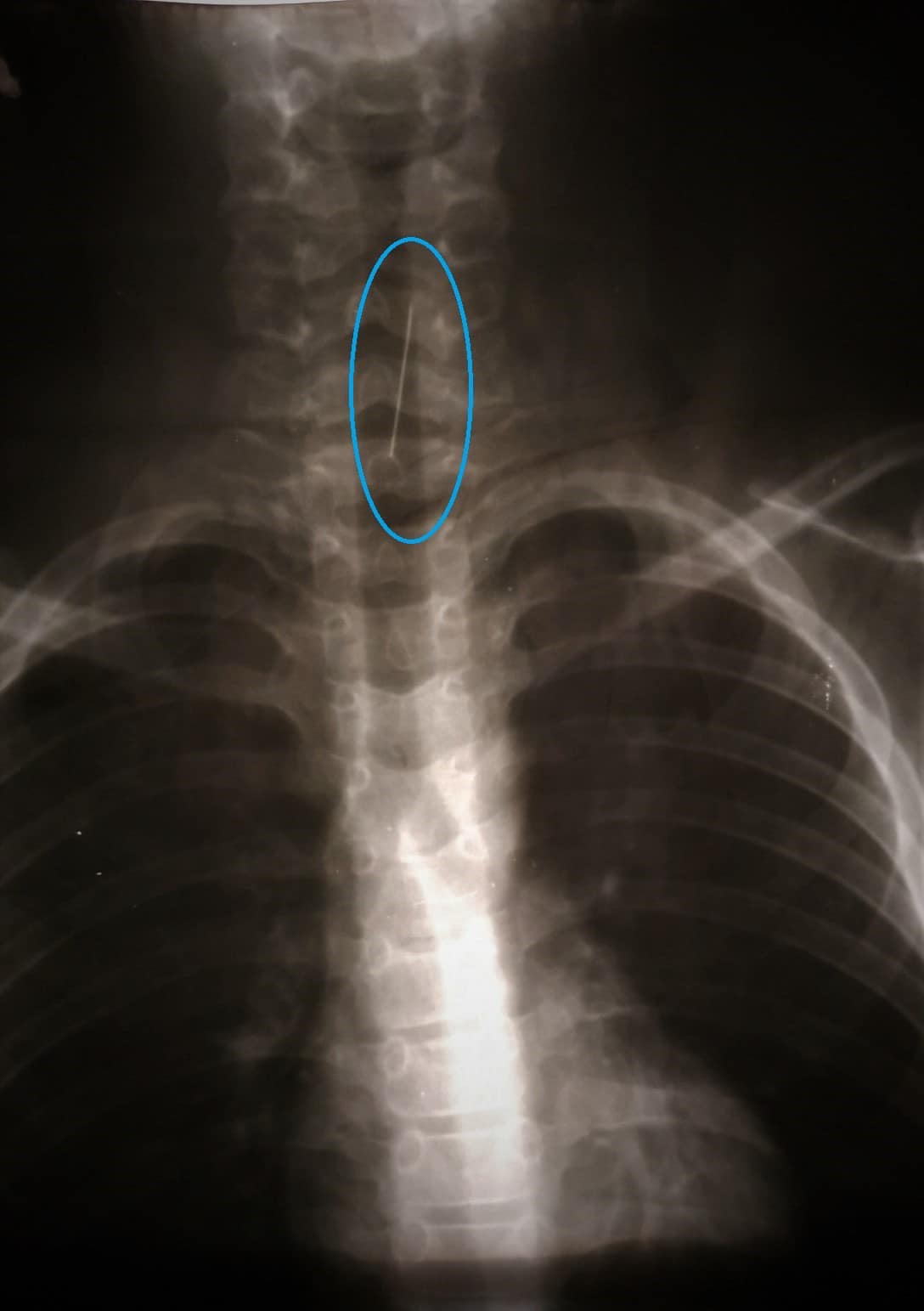 В Днепре спасали ребенка, который проглотил булавку/ фото: facebook.com/Дніпропетровська обласна дитяча лікарня 