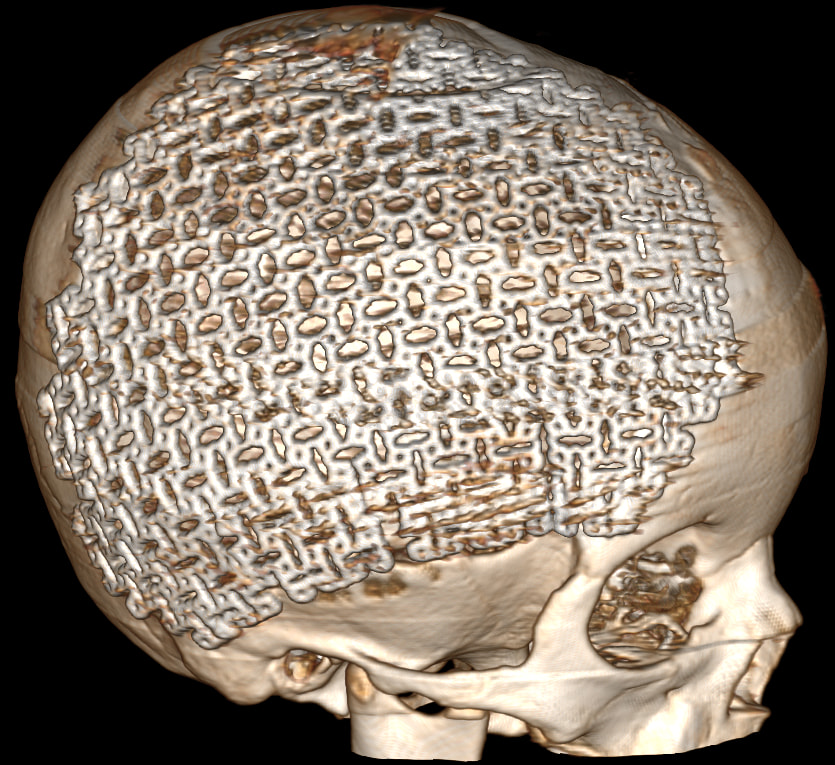 Титановый имплант/ фото: fb Днепропетровской областной детской больницы