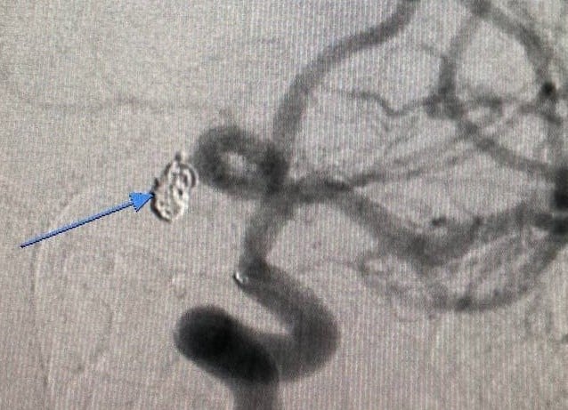 Кровь в головном мозге беременной.