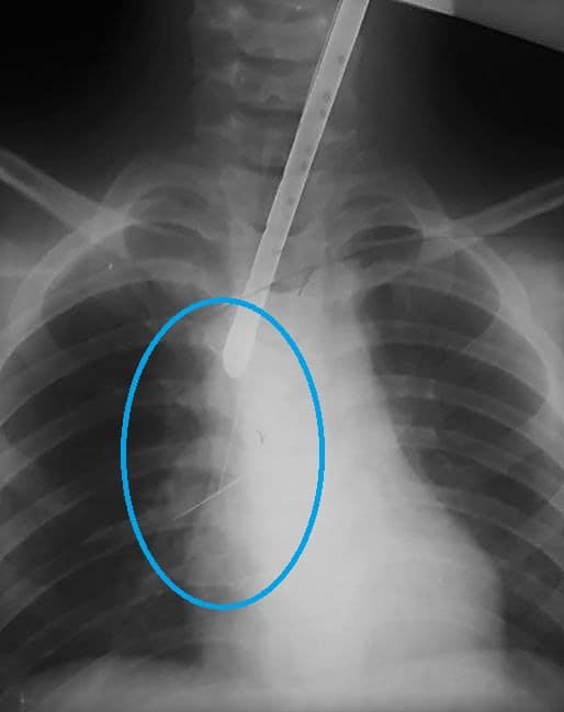 В Днепре спасали ребенка, который проглотил булавку/ фото: facebook.com/Дніпропетровська обласна дитяча лікарня 