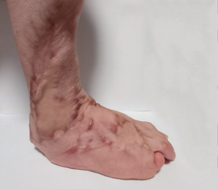 Нога мальчика, который попал в ДТП/ фото: Вiдкритий