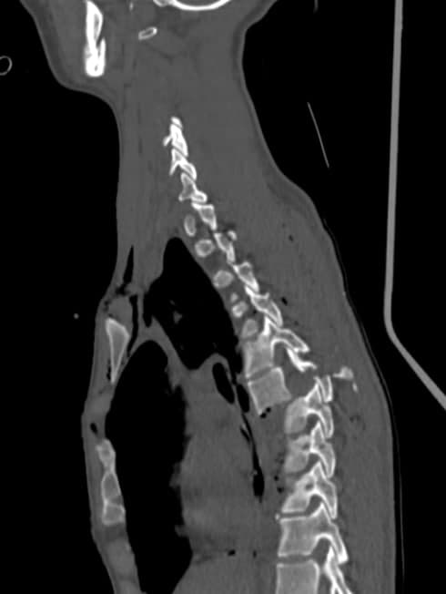 Позвоночник пострадавшей в ДТП после операции/ фото: fb Сергея Рыженко