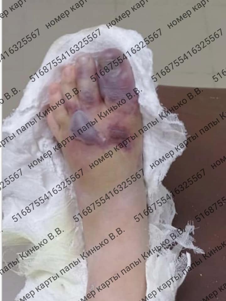 Девочка повредила ногу / фото: fb Ксения Пантюшкина