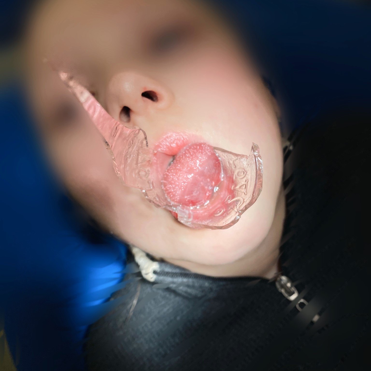 В Днепре спасли малыша с необычной травмой / фото: fb Відділення хірургії захворювань голови та шиї - МЦ ім проф М Ф Руднєва