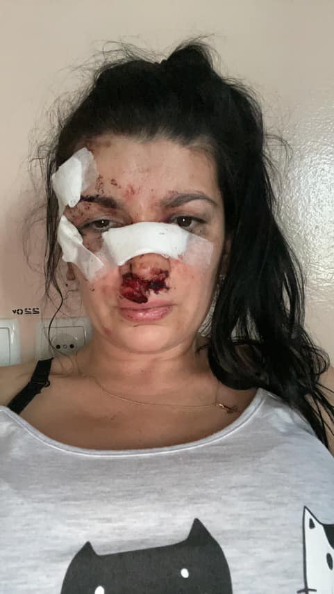 Как чувствует себя пострадавшая женщина - фото: fb Наташа Эшонкулова