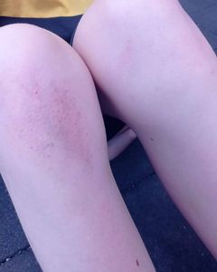 У мальчика ушибы –