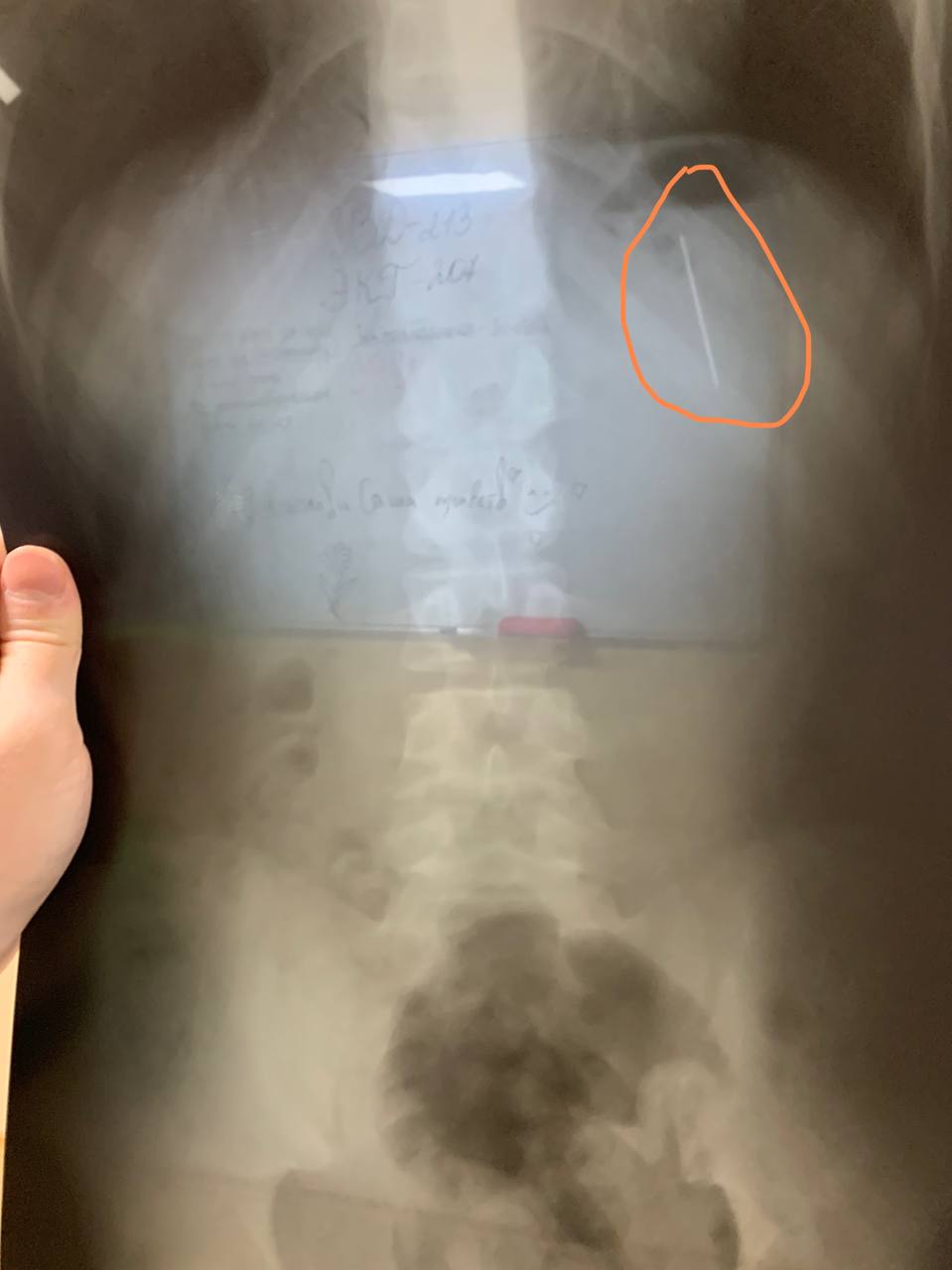 В Днепре ребенок проглотил иглу