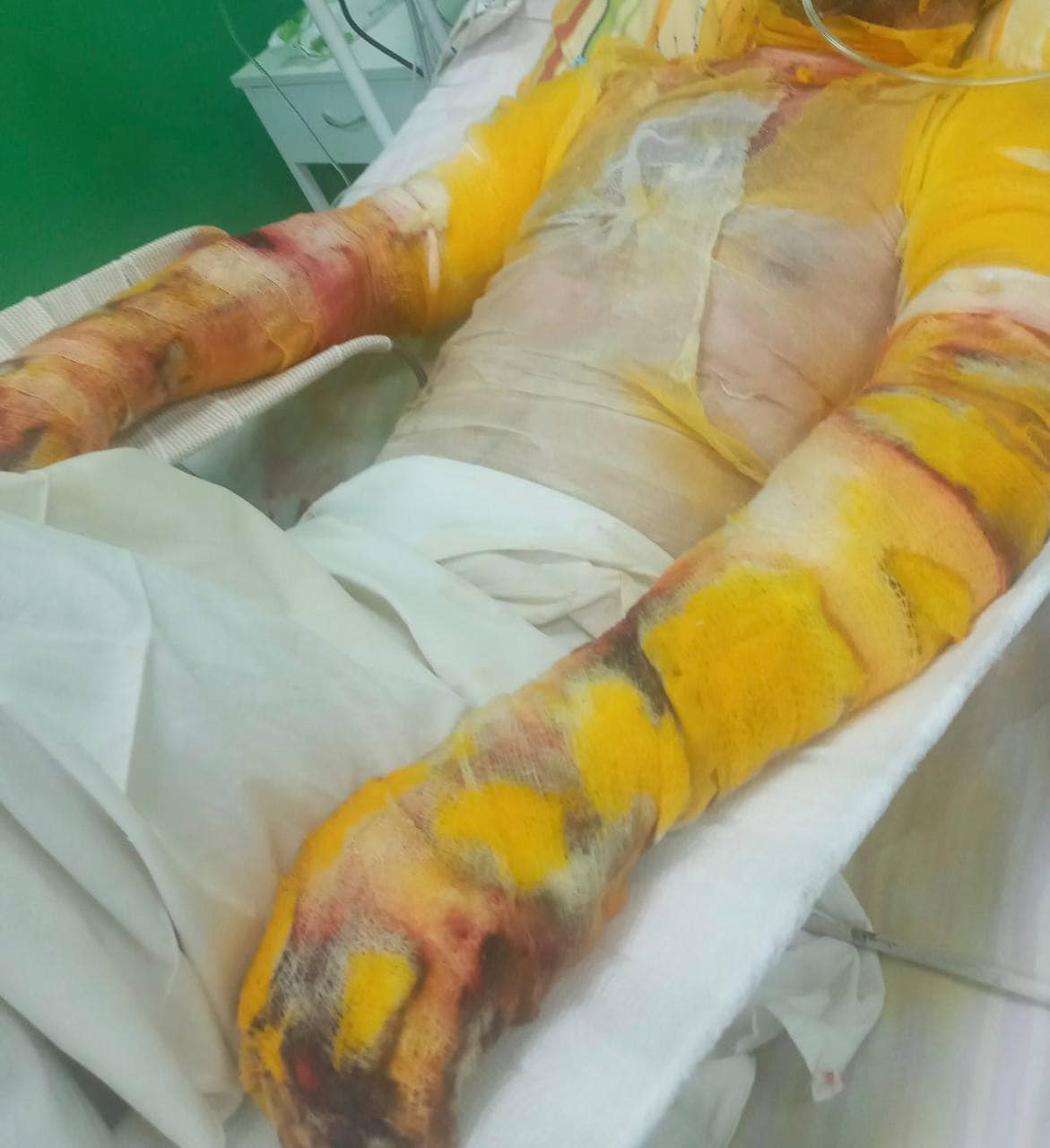 Військовому обпекло 65% тіла