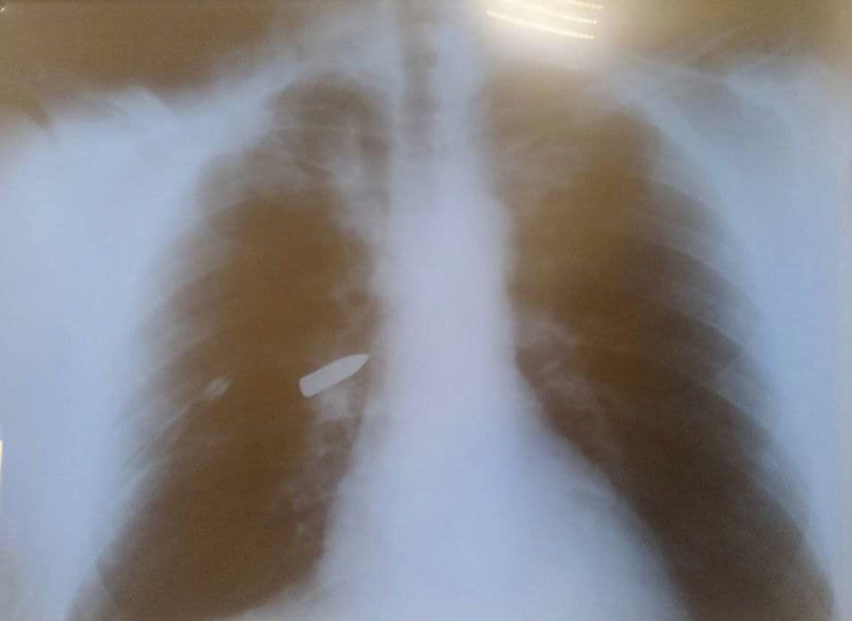 Врачи спасли бойца с пулей в легких - фото: facebook.com/dniprozdrav