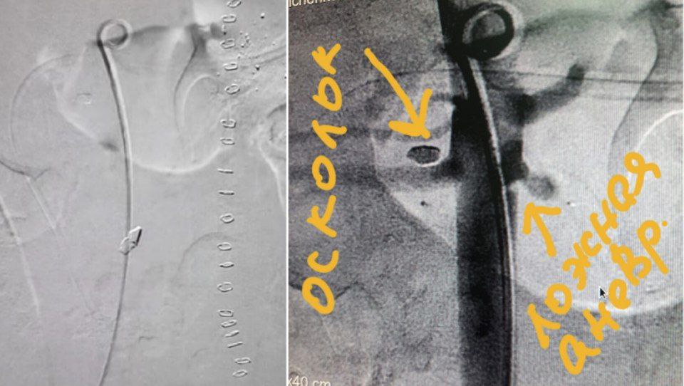 В Днепре провели уникальную операцию военному