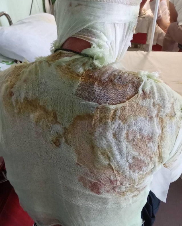 Военный получил тяжелые ожоги - фото: facebook.com/dniprozdrav