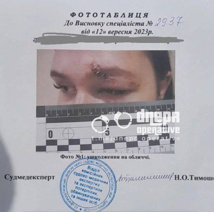 Накладені 4 шва навколо ока -