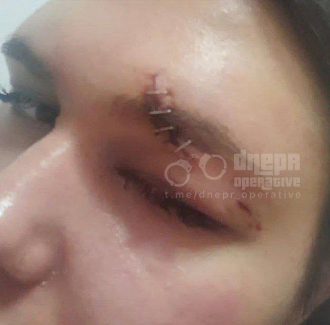 Накладені 4 шва навколо ока -